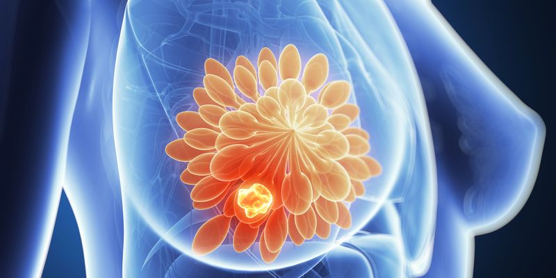 戈沙妥珠单抗一线治疗新突破:显著改善PD-L1阴性三阴性乳腺癌患者生存期
