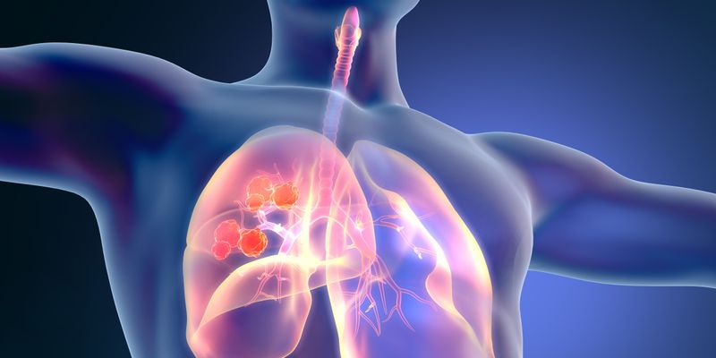 伊非那妥单抗治疗小细胞肺癌脑转移:IDeate-Lung01研究揭示显著颅内疗效