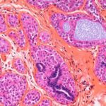 乳腺原位癌治疗后还担心复发？新型基因检测PRS313或能预测未来风险