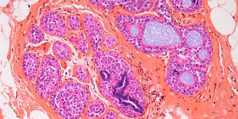 乳腺原位癌治疗后还担心复发?新型基因检测PRS313或能预测未来风险