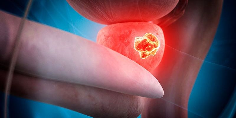 PSMA-PET引导放疗：前列腺癌治疗新曙光，失败风险降低一半