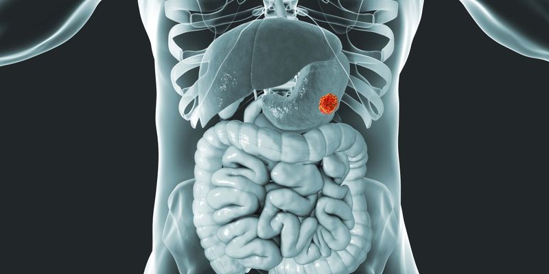 度伐利尤单抗联合FLOT化疗显著改善可切除胃癌总生存期,树立治疗新标杆