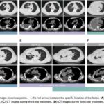 伏美替尼挑战罕见EGFR ex20ins突变：舒沃替尼耐药后，非小细胞肺癌患者PFS超10个月