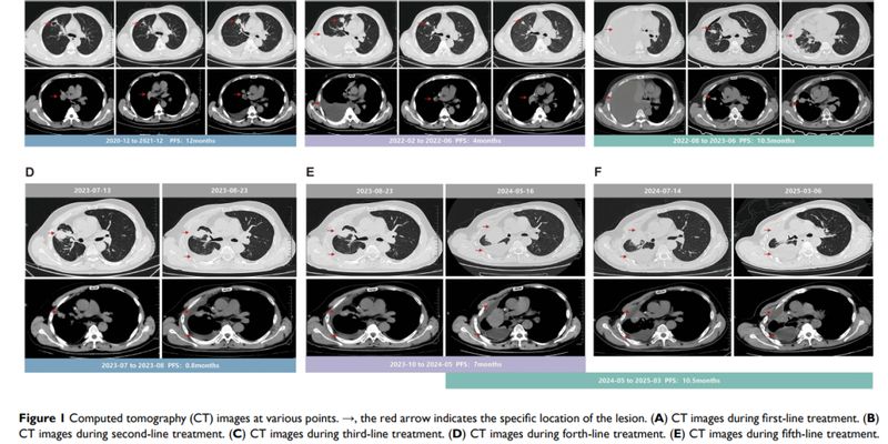 伏美替尼挑战罕见EGFR ex20ins突变:舒沃替尼耐药后,非小细胞肺癌患者PFS超10个月