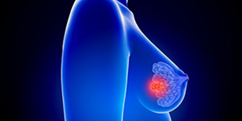 三阴性乳腺癌新辅助化疗添新证:卡铂显著改善绝经前患者生存率