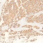 PSMA阳性意味着什么？前列腺癌诊断与治疗的关键标志物解读