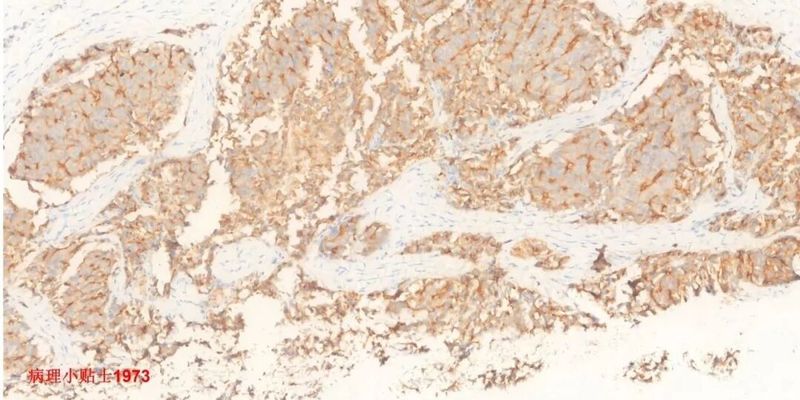 PSMA阳性意味着什么?前列腺癌诊断与治疗的关键标志物解读