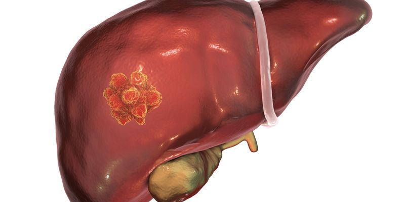 肝细胞癌一线治疗新探索:Tiragolumab联合“T+A”方案未能改善PFS
