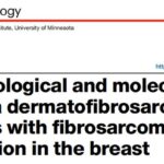 罕见乳腺肿瘤诊断新思路：COL1A1::PDGFB融合基因检测如何精准识别皮肤隆突性纤维肉瘤？