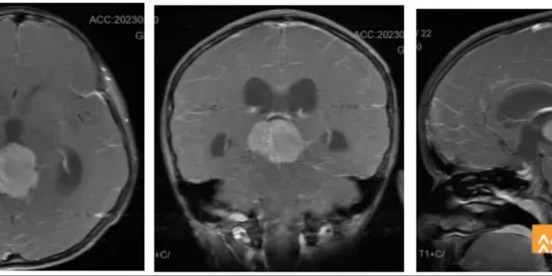 9岁儿童脑瘤复发迎转机：顺铂+替尼泊苷化疗方案实现生殖细胞瘤完全缓解