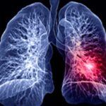 TKI耐药后新选择！Sacituzumab Tirumotecan治疗EGFR突变肺癌PFS翻倍