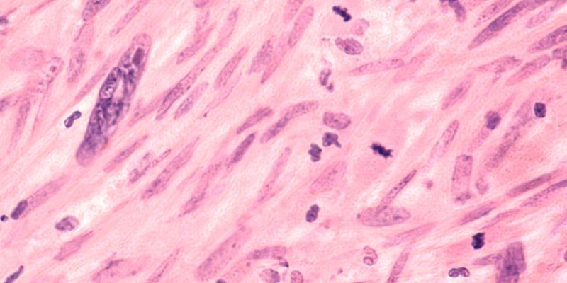 FDA加速审批!新型ADC药物ADCE-D01为软组织肉瘤患者点燃新希望