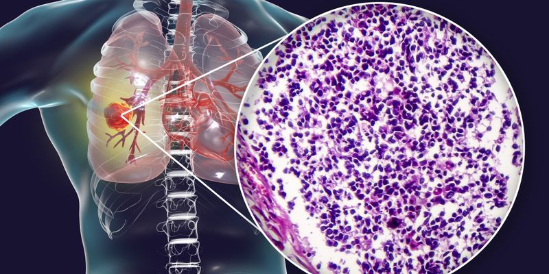 广泛期小细胞肺癌新药Tarlatamab:如何有效监测和管理CRS等副作用?