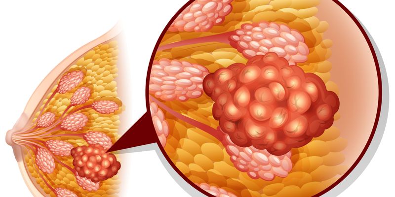阿贝西利显著延长生存期：monarchE研究揭示HR+/HER2-早期乳腺癌治疗新突破