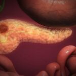 胰腺癌新希望：美法仑疗法在BRCA突变患者中取得14.2个月无进展生存期