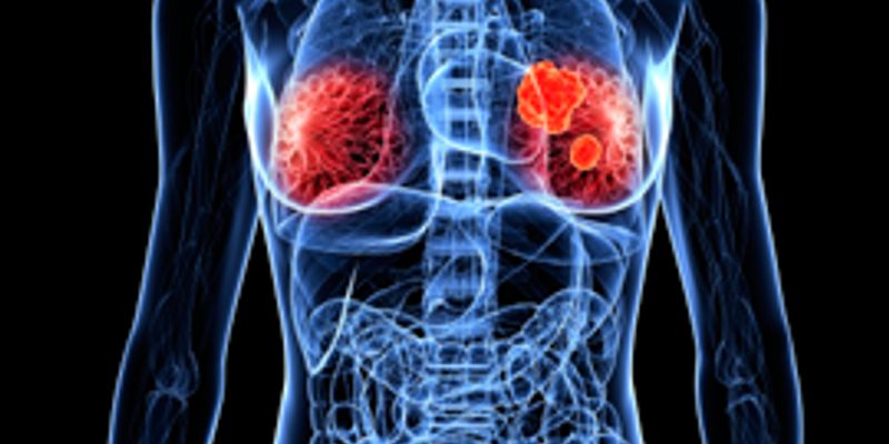 TROP2靶向ADC革新三阴性乳腺癌一线治疗:戈沙妥珠单抗等新药疗效解读