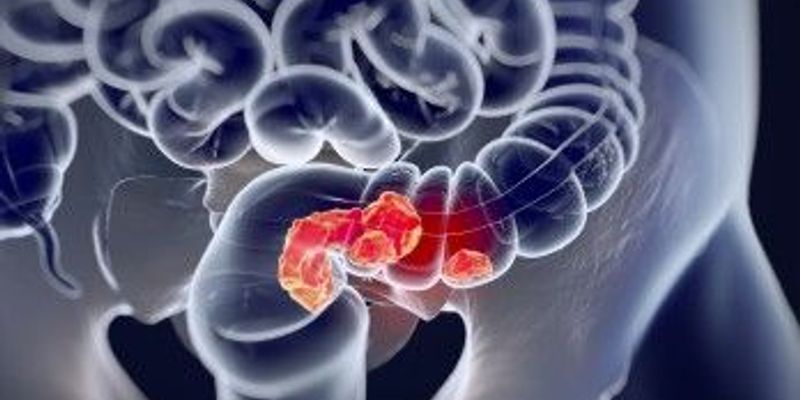 结直肠癌术后新希望:辅助治疗清除ctDNA,显著延长无病生存期