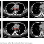 恩沙替尼挑战多基因突变肺腺癌：ALK+患者获益超30个月案例分享