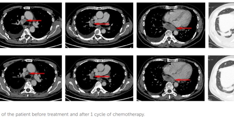 恩沙替尼挑战多基因突变肺腺癌:ALK+患者获益超30个月案例分享