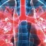 晚期肺癌治疗新突破：NK细胞疗法如何让肿瘤消失？真实案例解读