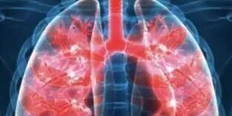 晚期肺癌治疗新突破:NK细胞疗法如何让肿瘤消失?真实案例解读
