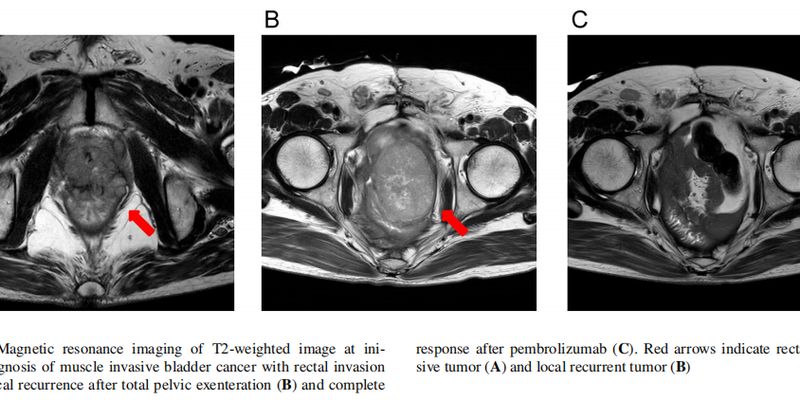 免疫治疗新篇章:帕博利珠单抗助力dMMR/MSI-H尿路上皮癌患者实现完全缓解