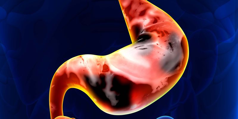 斯鲁利单抗联合化疗显著改善早期胃癌生存期，ASTRUM-006研究获积极结果