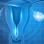 宫颈癌患者必读：放疗与放化疗如何影响术后生活质量？GOG-0263研究深度解析