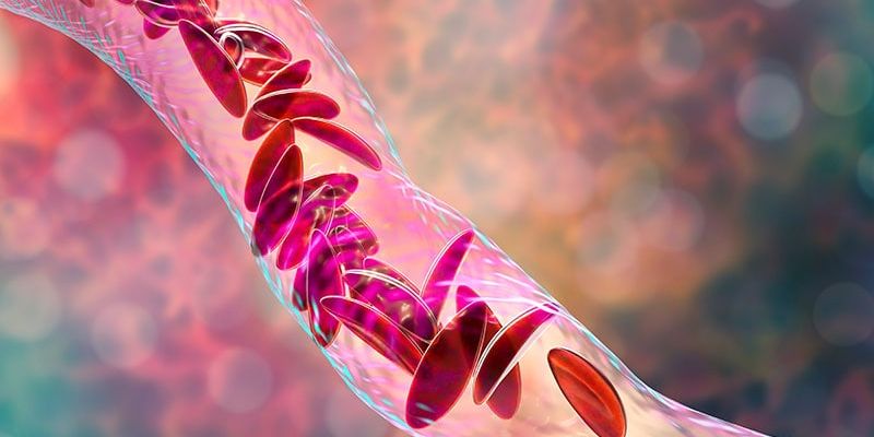 深入了解镰状细胞病：来自阿曼的独特基因图谱与治疗启示