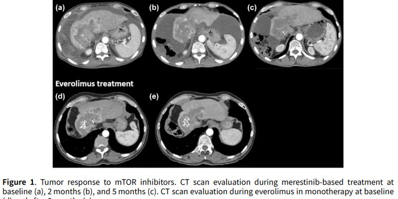 罕见肝内胆管癌病例：基因检测锁定TSC1/ARID1A突变，mTOR靶向治疗力挽狂澜