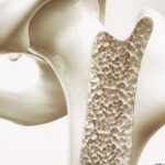 地舒单抗生物类似药获FDA“可互换”认证，治疗骨质疏松与癌症骨转移添新选择