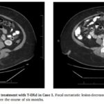 德曲妥珠单抗治疗妇科肿瘤：IHC阴性不等于无效，HER2突变是关键！