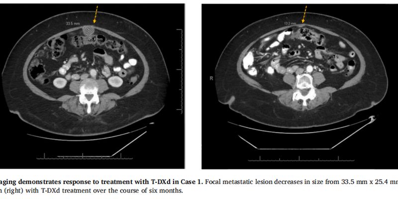 德曲妥珠单抗治疗妇科肿瘤:IHC阴性不等于无效,HER2突变是关键!