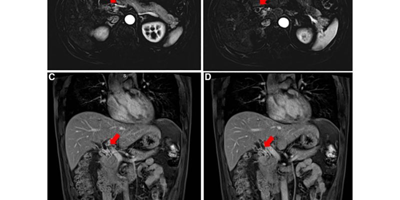 HER2扩增胆管癌新希望：德曲妥珠单抗显奇效，联合仑伐替尼克服耐药