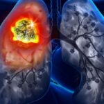 脑转移新希望：HER3-DXd在肺癌和乳腺癌治疗中显示强大颅内活性