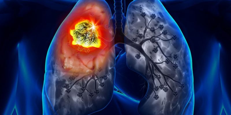 脑转移新希望：HER3-DXd在肺癌和乳腺癌治疗中显示强大颅内活性