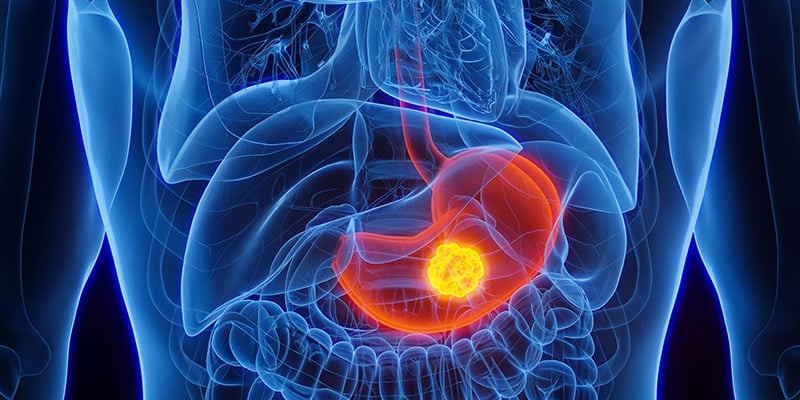 胃癌放疗怎么做？ASTRO首份官方指南详解最新治疗方案