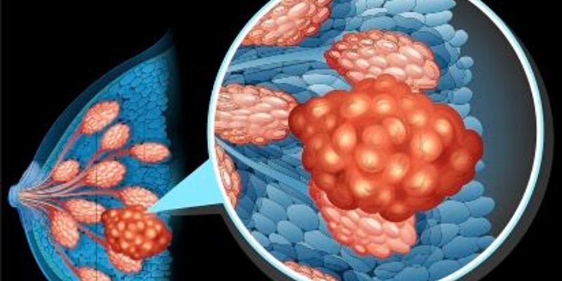 吉瑞司群(Giredestrant)辅助治疗新突破：lidERA研究证实可显著改善早期乳腺癌无病生存期