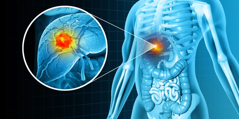 死亡风险降85%！研究证实：肝细胞癌免疫治疗后加做一步，生存获益巨大