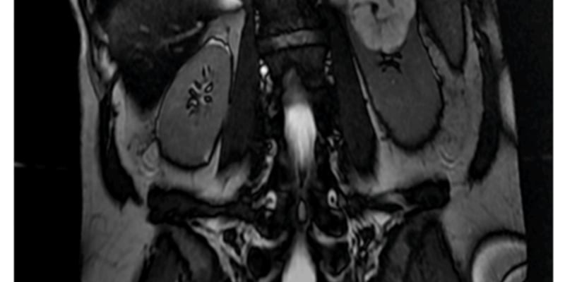 TFE3重排肾细胞癌：从高铁蛋白血症到罕见肾癌确诊，年轻患者如何应对？