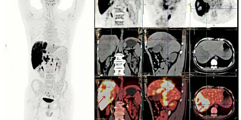 喉小涎腺癌肝转移治疗新突破：西妥昔单抗为EGFR阳性患者带来希望