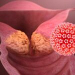 早期宫颈癌治疗新选择：保留生育功能手术虽增加复发风险，但不影响总生存率