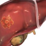 西米普利单抗联合SBRT新辅助治疗肝细胞癌：2年无病生存率高达88%！