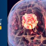 瑞戈非尼联合新方案治疗胶质母细胞瘤：REGOMA-2研究公布积极数据