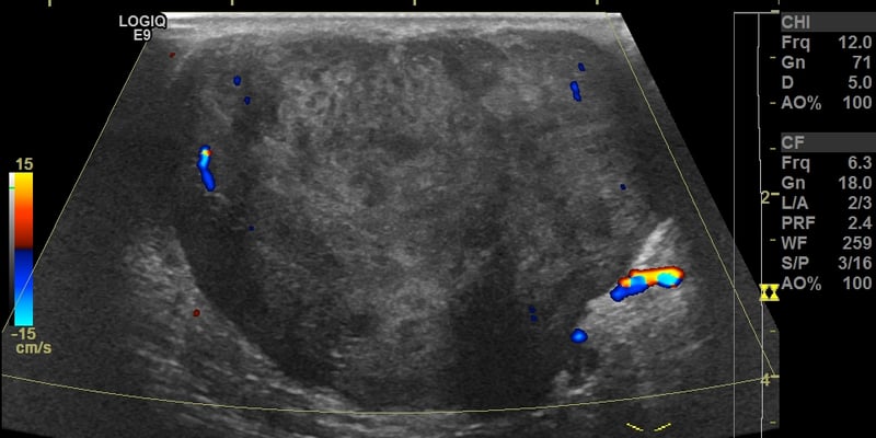 腹部肿块竟是罕见骨外骨肉瘤？一文读懂诊断、治疗与预后