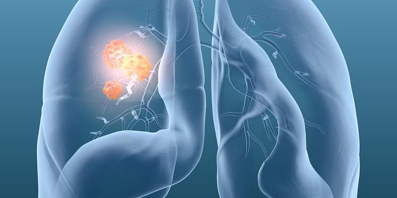 实体瘤治疗新篇章：脉冲电场消融术不仅有效控制肿瘤，更能激活全身免疫反应