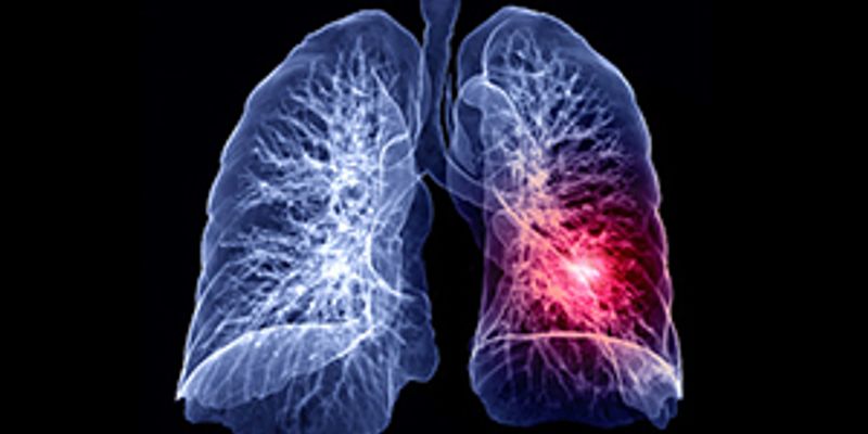 依沃西单抗一线治疗晚期鳞状NSCLC：PFS显著延长，优于替雷利珠单抗方案