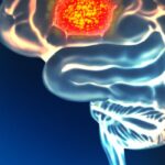 HER3-DXd突破：显著控制非小细胞肺癌与乳腺癌脑转移，TUXEDO-3研究数据公布