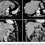 德曲妥珠单抗力挽狂澜：HER2低表达乳腺癌肝脏危象患者获1.5年缓解