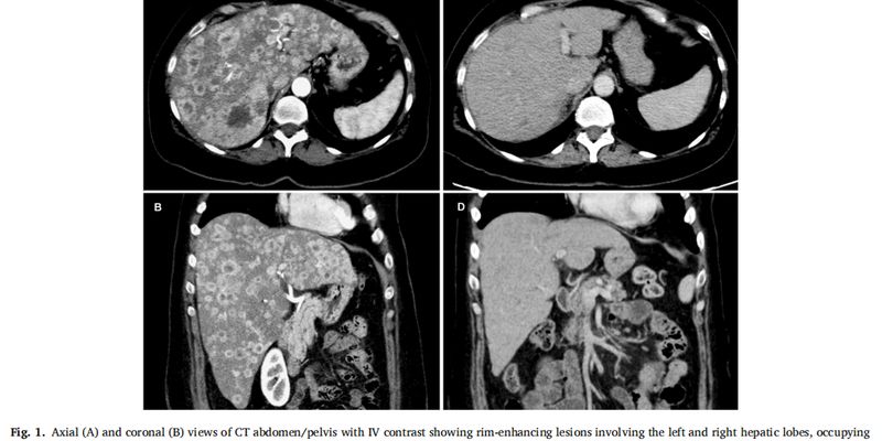 德曲妥珠单抗力挽狂澜：HER2低表达乳腺癌肝脏危象患者获1.5年缓解
